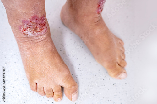 Quadro em tela Close up wound on lower leg with scars of adult female patient, legs with irrita