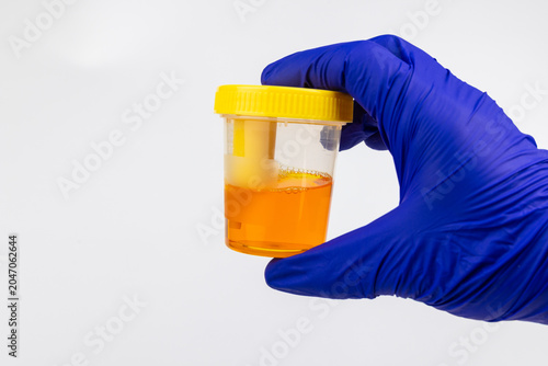 Tableau sur toile A hand in blue protective glove holding a plastic container filled with a yellow