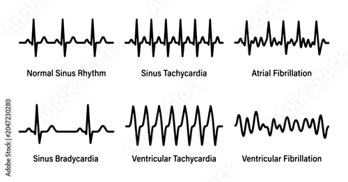 Foto ECG Heartbeat Waveforms: Arrhythmia Types, Medical Diagrams, Cardiac Rhythm