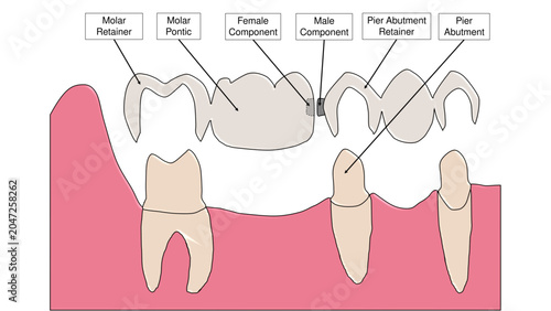 Foto Pier Abutment Fixed Partial Denture Non Rigid Connector Dental Diagram - Labelle