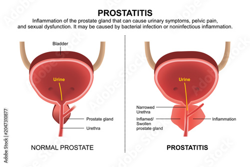 Bild auf Leinwand Prostatitis, Inflammed Prostate Gland Illustration