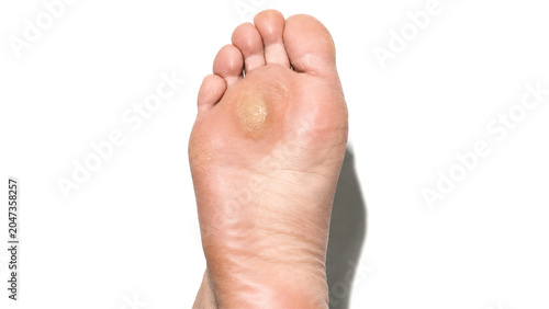 human foot with large callus on the sole. Dermatological problem showing rough skin thickening. Podiatry health concept for foot care, skin treatment, and medical condition analysis