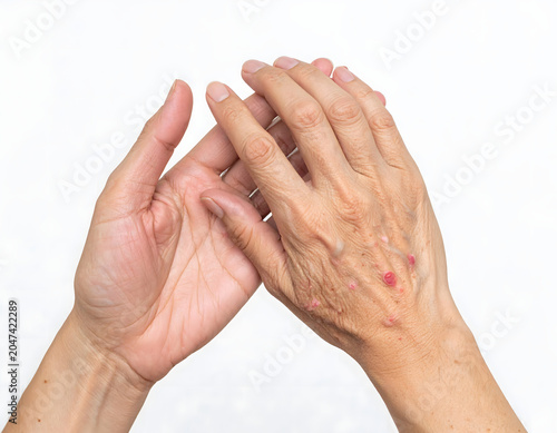 A close-up of two hands, one with clear skin and the other showing signs of aging and skin irritation, against a plain white background. The aged hand displays wrinkles, prominent veins.