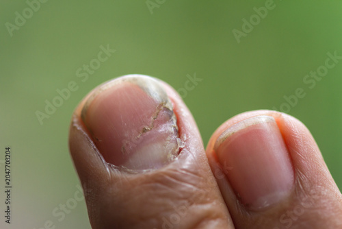 close up onychomycosis