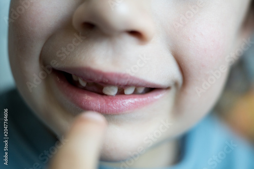 Tableau sur toile Close-up shot capturing a child's smiling mouth as they direct an index finger towards a gap in their front teeth