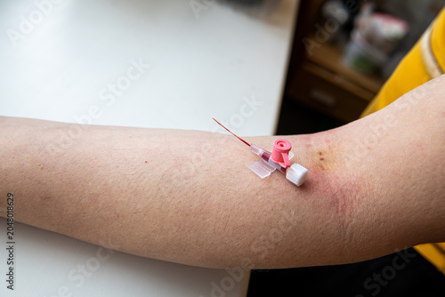 Fotografie Human arm with visible marks immediately after intravenous cannula needle remova