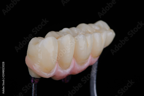 Dental bridge with artificial gum made of zirconium on three titanium abutments to fixation on implant