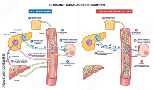 Foto Hormone imbalance in diabetes shown as side-by-side schema of normal vs insulin resistance, highlighting pancreas, blood vessel, and liver regulating glucose and insulin