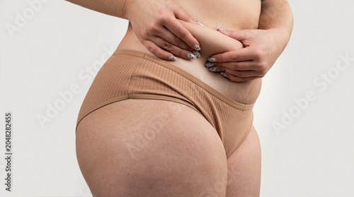 Tablou pe pânză Woman pinching abdominal fat with visible cellulite
