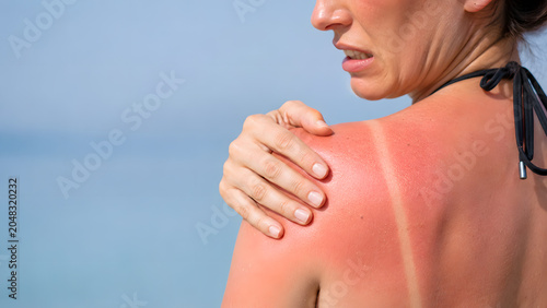 Woman Touching Sunburned Shoulder with Visible Swimsuit Tan Line, Sun Damage Awareness Photography
