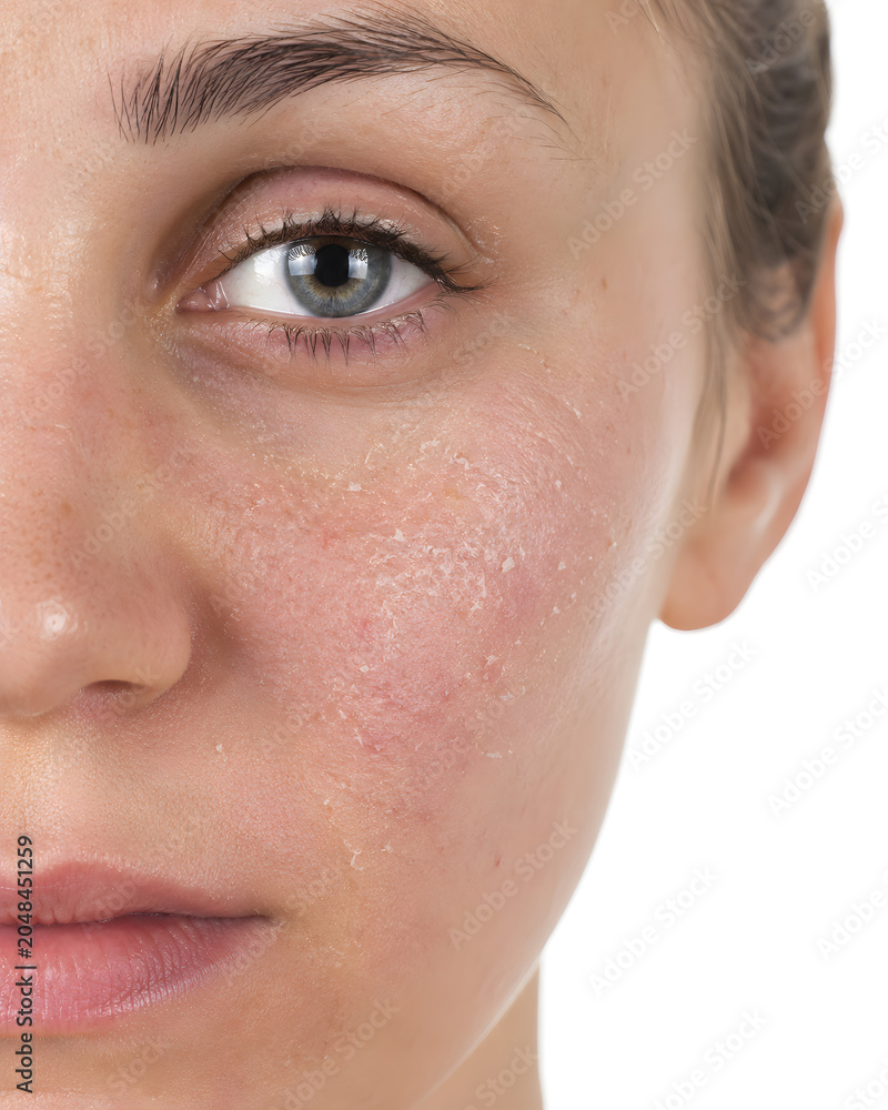 Fototapeta premium Close Up Dry Flaky Skin and Red Irritation on Woman Cheek