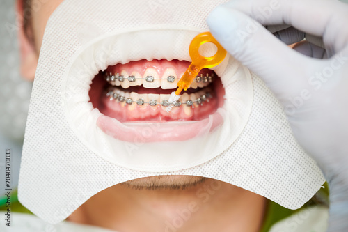 Quadro su tela Close up of dentist using special brush to clean between teeth and braces