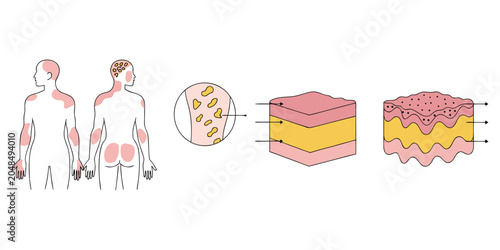 Canvastavla Psoriasis skin condition medical infographic diagram with body lesions and cross section vector illustration