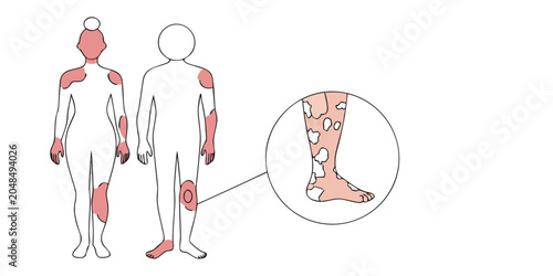 Photos Psoriasis skin condition medical infographic diagram with body lesions and cross section vector illustration