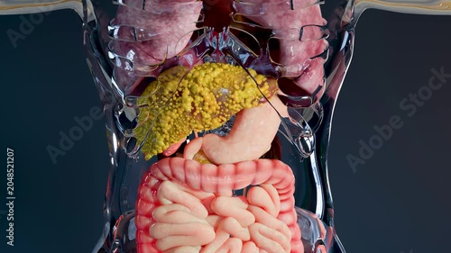 Fatty Liver (Steatosis): Lipid Droplet Accumulation, Hepatic Steatosis: Fatty Liver Disease, Fat Deposits in Liver Cells (Hepatocytes), 3d render