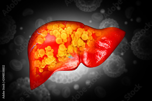 Liver damage such as Fatty liver, Fibrosis, Cirrhosis, and Liver cancer. 3d illustration