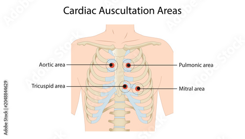 Bild auf Leinwand Cardiac Auscultation Areas,  cardiac auscultation areas used to assess heart sounds and murmurs associated with the aortic, pulmonic, tricuspid, and mitral valves