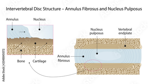 Foto Intervertebral Disc Structure – Annulus Fibrosus and Nucleus Pulposus, the structure of an intervertebral disc, highlighting the outer annulus fibrosus and central nucleus pulposus responsible