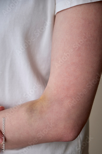 Slika na platnu Close-up of a Caucasian female arm featuring a large hematoma (bruise) on the inner elbow area (cubital fossa) caused by an unsuccessful intravenous injection or blood sampling