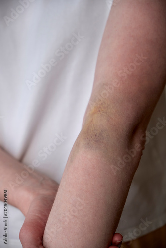 Foto Close-up of a Caucasian female arm featuring a large hematoma (bruise) on the inner elbow area (cubital fossa) caused by an unsuccessful intravenous injection or blood sampling