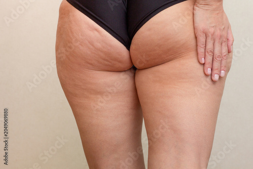 Female hand on thighs and buttocks with cellulite