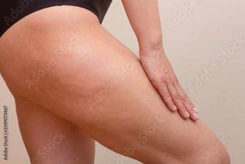 A detailed clinical close-up of the outer thigh area highlighting the uneven skin texture and dimpling characteristic of cellulite formation