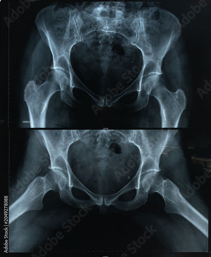Pelvic X-ray Scan Showing Hip Bones and Joint Structure in Medical Imaging