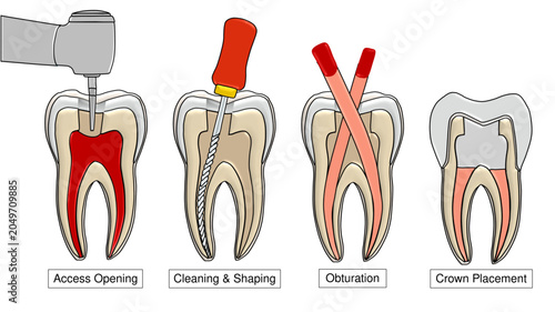 Photos Root Canal Treatment Steps Cross Section Endodontic Therapy Dental Vector - Labe