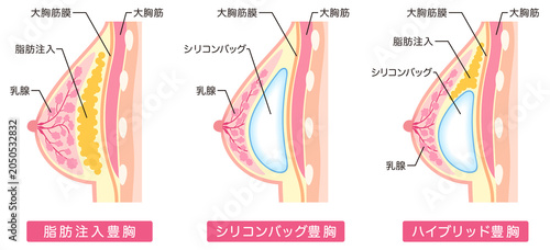 豊胸手術の種類　美容整形　胸