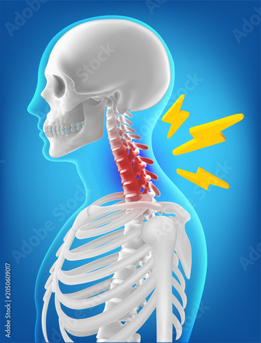 Vector 3d Cervical spine, neck pain, and orthopedic healthcare presentations.  indicate neck pain or injury
