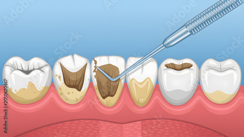 An illustration of dental cleaning with a scaler removing plaque from teeth