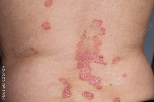 Quadro em tela Close-up of psoriasis lesions on the lower back, featuring red, inflamed patches