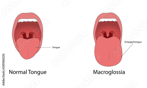 Foto Macroglossia vector illustration