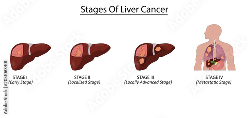 Tableau sur toile Stages of liver cancer vector illustration