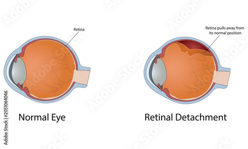 Obraz na płótnie Retinal detachment vector illustration
