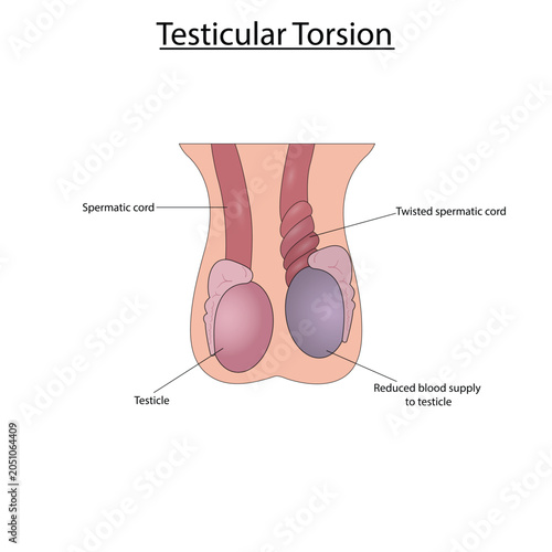 Bild auf Leinwand Testicular torsion vector illustration