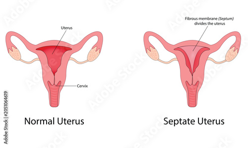 Bild auf Leinwand Uterine septum vector illustration