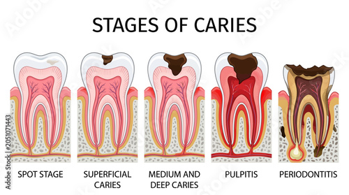 Infographic illustration showing stages of tooth decay, from spot to periodontitis.
