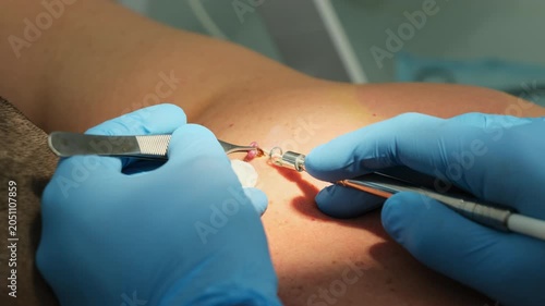 Dermatologist uses forceps and laser coagulation to remove mole from skin slow motion. Surgeon treat potential melanoma in hospital closeup