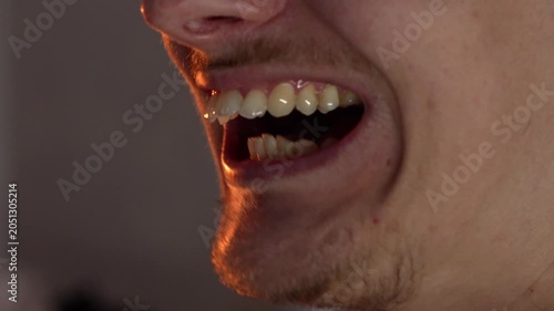 Protruding teeth in a man.
Malocclusion, large jaw
