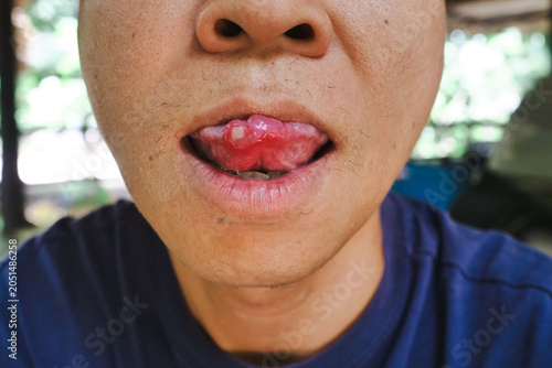 Cuadro en lienzo (Canker Sores) Mouth ulcer ,(Aphthous Ulcers)Mouth sores caused by allergies