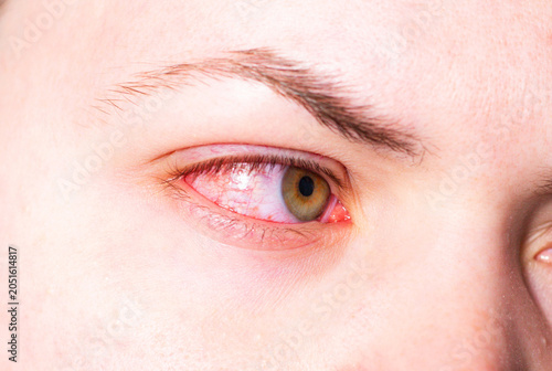 Fotografija Red eye due to viral or bacterial infection