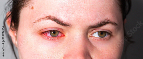 Foto Red eye due to viral or bacterial infection