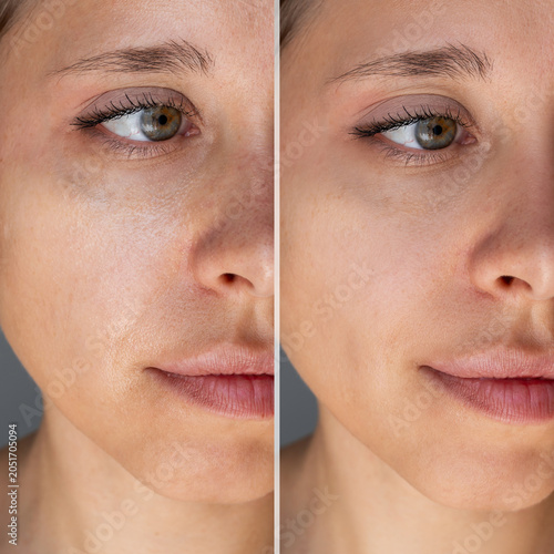 Before and after close up of female oily skin showing shiny greasy complexion and clean matte result. Skincare, sebum control, facial treatment and skin texture comparison concept