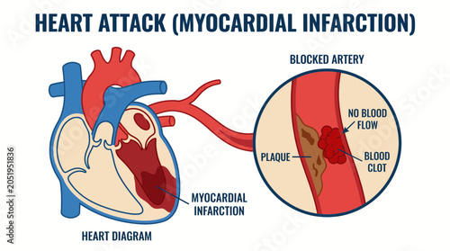 Tableau sur toile Heart Attack Myocardial Infarction Blocked Artery Medical Diagram