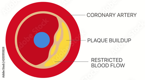 Foto Atherosclerotic Plaque Buildup Inside Coronary Artery Cross Section
