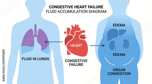 Obraz na plátne Congestive Heart Failure Fluid Accumulation Organ Diagram