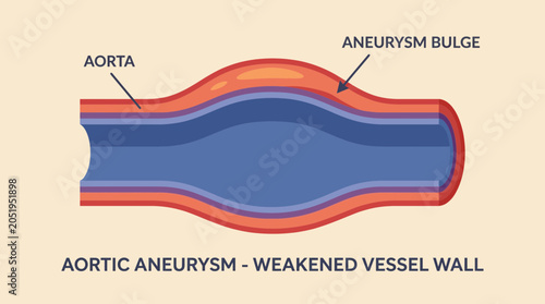 Photos Aortic Aneurysm Bulging Weakened Vessel Wall Cross Section