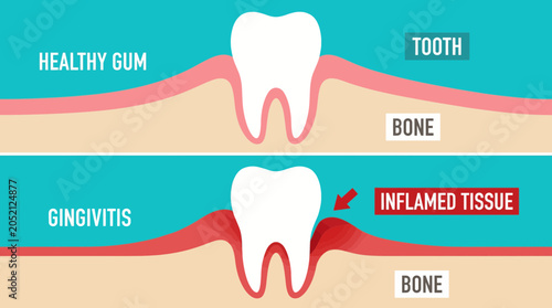 Bild auf Leinwand Gingivitis Inflamed Gum Tissue Diagram