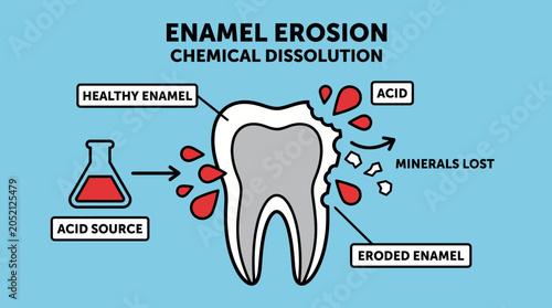 Photos Enamel Erosion Chemical Dissolution Illustration